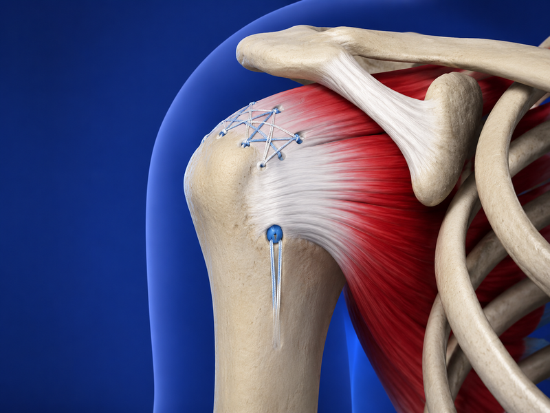 Rotator Cuff Repair